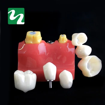 1 buc 4-ori de Plantare pe Dinți Model de Predare Orala Modelul Patologiei Dentare Model Pentru Stomatologie Laborator