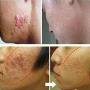 LANBENA ginseng esența îndepărtarea cicatrice acnee crema de îngrijire a feței Pete Acnee de îngrijire a pielii tratament de albire crema de vergeturi 30ml