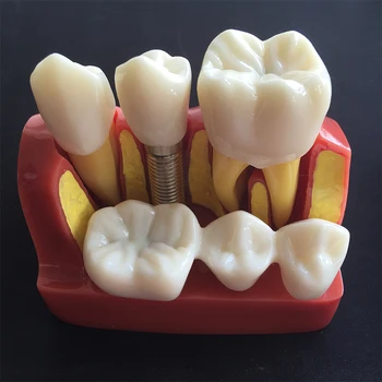 1 buc 4-ori de Plantare pe Dinți Model de Predare Orala Modelul Patologiei Dentare Model Pentru Stomatologie Laborator